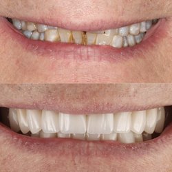 Smile rejuvenation by Dr. Miller