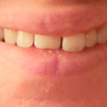 Monica Crooks, DDS - Before smile transformation. Teeth were spaced, one larger and shorter than the other. - Cosmetic Dentists Near Me - Sacramento, California Monica Crooks, DDS - Before smile transformation. Teeth were spaced, one larger and shorter than the other. - Cosmetic Dentists Near Me - Sacramento, California