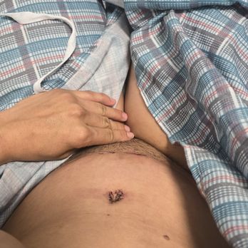 Dr K Plastic Surgery Orange County - Painful crooked & botched belly button after Tummy Tuck with Kalantarian - Cosmetic Surgeons Near Me - Irvine, California Dr K Plastic Surgery Orange County - Painful crooked & botched belly button after Tummy Tuck with Kalantarian - Cosmetic Surgeons Near Me - Irvine, California