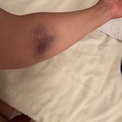 Quest Diagnostics - This is the bruise ten days after blood draw.