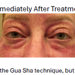 Red Cupping Clinic - Puffiness around your eyes? This patient saw dramatic results after just one treatment. Results vary per patient and intensity.