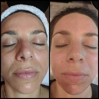 newGLO - Post GLO facial - Skin Care Near Me - Brentwood, California