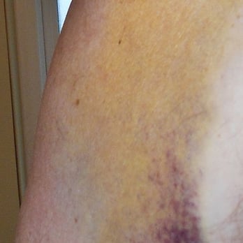 Arrowhead Orthopaedics-Riverside - HUGE black and blue bicep due to my Rotator Cuff tear. - Physical Therapy Near Me - Riverside, California