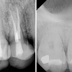 A fractured tooth removed and replaced with an implant, one visit appointment.
