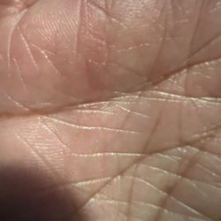 OrthoVirginia - Trigger release- can you find it! Dr. Desai is amazing. Anything wrong with your hands - go to him