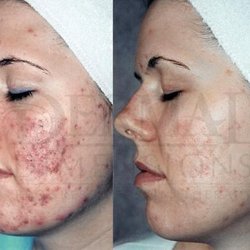 Dermal Dimensions Progressive Skin Therapy - Acne and scar improvement.