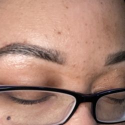 The Beauty Doc - Left side - 1 year retouch