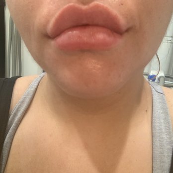 LaserAway - After!! LOVE THE RESULT - Laser Hair Removal Near Me - San Jose, California