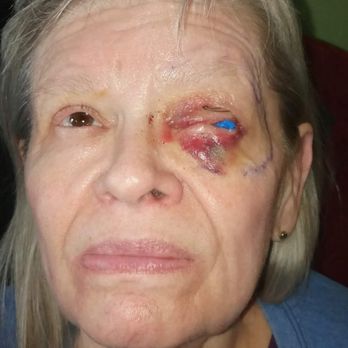 Boling Vision Center - Lost an eye due to a botched surgery from Boling. - Ophthalmologists Near Me - South Bend, Indiana Boling Vision Center - Lost an eye due to a botched surgery from Boling. - Ophthalmologists Near Me - South Bend, Indiana