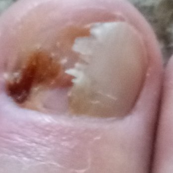 Tracy Basso - Big toe, right foot. totally wrecked - Podiatrists Near Me - Davis, California