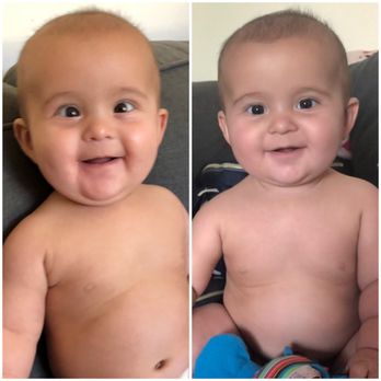 Walter M Fierson, MD, PC - One week before surgery vs one week after - Ophthalmologists Near Me - Arcadia, California Walter M Fierson, MD, PC - One week before surgery vs one week after - Ophthalmologists Near Me - Arcadia, California