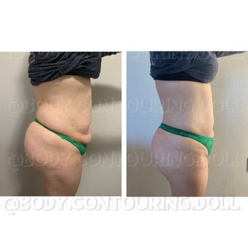 Body Contouring Doll - Noninvasive BBL correction - Teeth Whitening Near Me