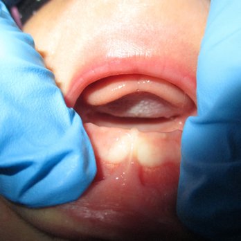 Team Tongue Tie - Upper lip before procedure - Lactation Services Near Me - Morehead, Kentucky