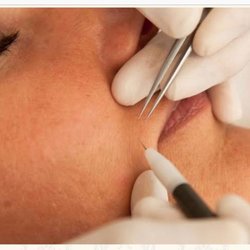 Camille's Electrolysis - Electrolysis facial hair removal