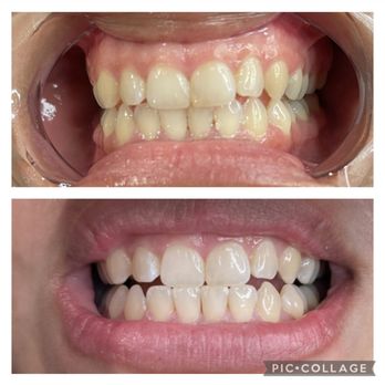Bare Beauty KD - Teeth Whitening Near Me Bare Beauty KD - Teeth Whitening Near Me