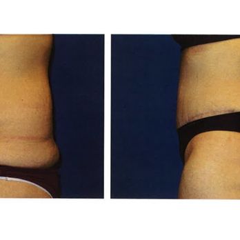 Troy J. Andreasen M.D - Lipo 360 & tummy tuck Before taken in pre op, After 6 weeks post op - Cosmetic Surgeons Near Me - Bldg #3 Ontario, California Troy J. Andreasen M.D - Lipo 360 & tummy tuck Before taken in pre op, After 6 weeks post op - Cosmetic Surgeons Near Me - Bldg #3 Ontario, California