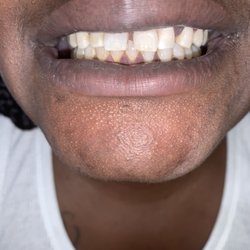 Glowing Smiles Teeth Whitening - After advance whitening