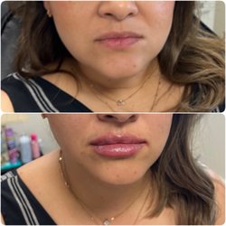 Mariams Aesthetic Clinic - Lip fillers