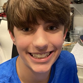Los Altos Orthodontics - First set of aligners - Orthodontists Near Me - Los Altos, California Los Altos Orthodontics - First set of aligners - Orthodontists Near Me - Los Altos, California