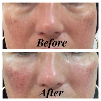 ShotDocMD - Tear trough filling with cheek lift using 1.5cc Radiesse with microcannula - no bruise technique. - Medical Spas Near Me - Los Gatos, California