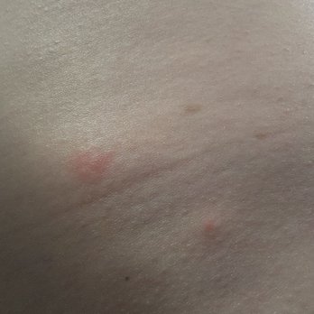 Lake Compounce Campground - Bedbug bites - Campgrounds Near Me - Bristol, Connecticut