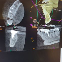 Tushar B Patel, DDS - Arrow Endodontics - All healed!!