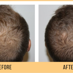 A Midas Touch Med Spa - Keravive® Scalp Treatments. Non invasive and non painful.