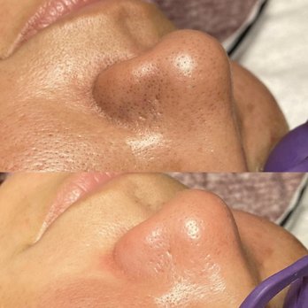 HayleyAnn Beauty - Blackhead removal with enzymes - Eyelash Service Near Me - Austin, Texas HayleyAnn Beauty - Blackhead removal with enzymes - Eyelash Service Near Me - Austin, Texas