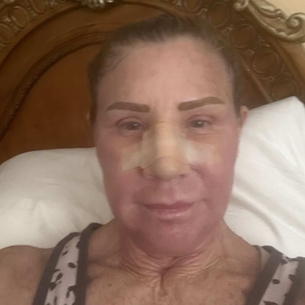 Blue Illusion Beauty - A week after surgery - Medical Spas Near Me - Carlsbad, California Blue Illusion Beauty - A week after surgery - Medical Spas Near Me - Carlsbad, California
