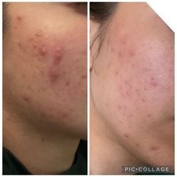 Reje Aesthetics - Chemical peels