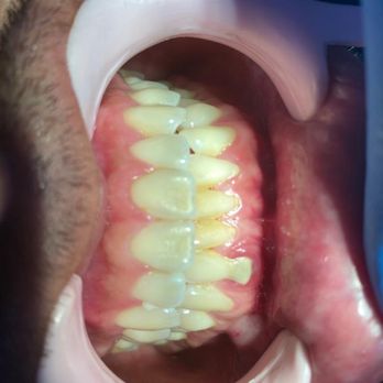 Dental Perfect - Before - General Dentistry Near Me - México, D.F., DIF