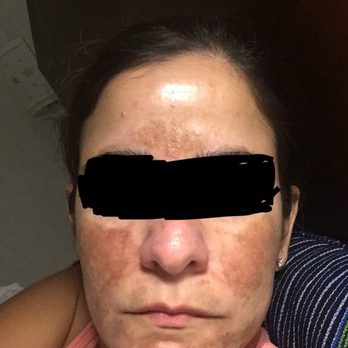 Emerald Coast Med Spa & Wellness - This is what my face looks like now. - Medical Spas Near Me - Navarre, Florida Emerald Coast Med Spa & Wellness - This is what my face looks like now. - Medical Spas Near Me - Navarre, Florida