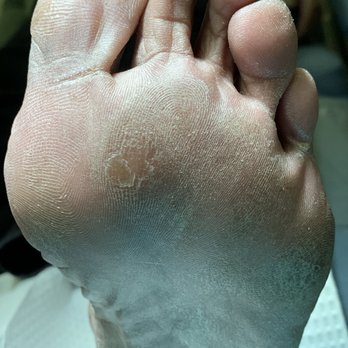 Jacob Foot and Ankle Associates - Callus - Podiatrists Near Me - Burlington, New Jersey Jacob Foot and Ankle Associates - Callus - Podiatrists Near Me - Burlington, New Jersey