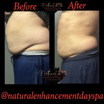 Natural Enhancement Day Spa - Body Contouring Near Me - Greensboro, North Carolina Natural Enhancement Day Spa - Body Contouring Near Me - Greensboro, North Carolina
