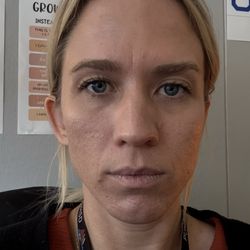 Lux MD - Before