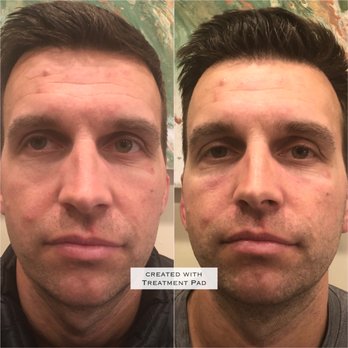 Cryo Transformations - Look at the difference! - Cryotherapy Near Me - Los Angeles, California Cryo Transformations - Look at the difference! - Cryotherapy Near Me - Los Angeles, California