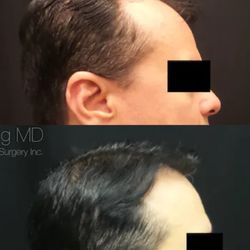 Hair Transplant Hawaii