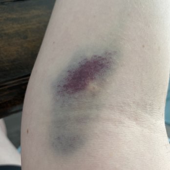 Wasatch Infusion - Arm - IV Hydration Near Me - Murray, Utah