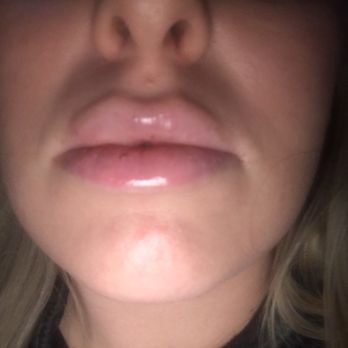 Perfect Skin Center - Lip injections by dr. B no bruising at all! - Skin Care Near Me - Tempe, Arizona Perfect Skin Center - Lip injections by dr. B no bruising at all! - Skin Care Near Me - Tempe, Arizona