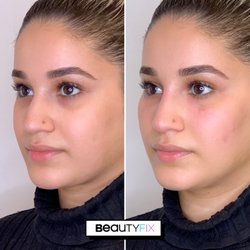 BeautyFix MedSpa - Cheek & EyeFix which is the perfect combination to deliver rejuvenated results in one quick & easy treatment.