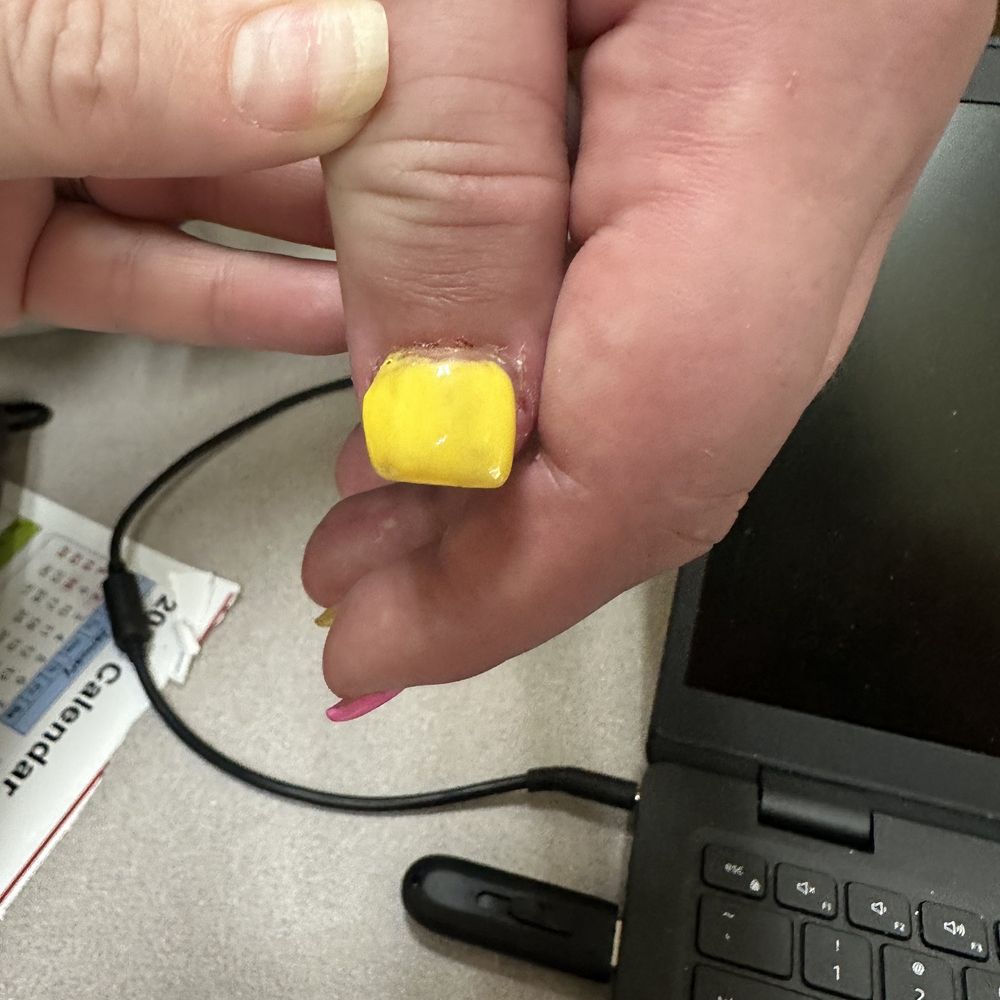 City Nails - Thumb nail. Look at the side it is not smooth and has a knot on it. - Nail Salons Near Me - Batesville, Arkansas City Nails - Thumb nail. Look at the side it is not smooth and has a knot on it. - Nail Salons Near Me - Batesville, Arkansas