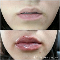 A Perfect You - Lip filler before and after