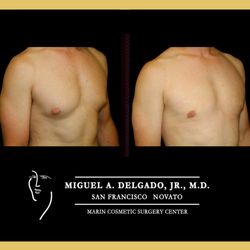 Gynecomastia - Gynecomastia- Also specialize in best facelift, mini-facelift, tummy tuck, mini-tummy tuck in Napa Valley, Sonoma County, San Francisco