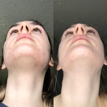 Kalon Skin Studio - November 10th (left) December 21st after 2nd facial (right) - Skin Care Near Me - Pearland, Texas Kalon Skin Studio - November 10th (left) December 21st after 2nd facial (right) - Skin Care Near Me - Pearland, Texas