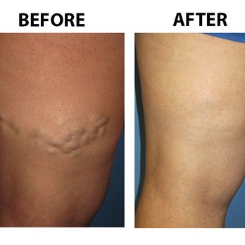 Miller Vein - Macomb - Vascular Medicine Near Me - Macomb Township, Michigan Miller Vein - Macomb - Vascular Medicine Near Me - Macomb Township, Michigan