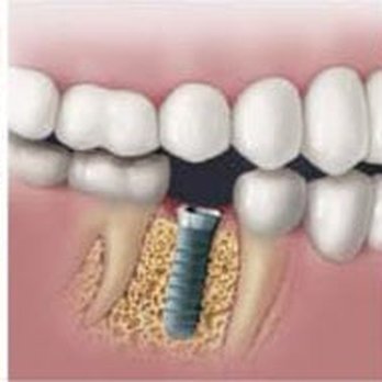 The Downey Dentist - Dental Implants to Replace a Missing or Broken Tooth - General Dentistry Near Me - Downey, California The Downey Dentist - Dental Implants to Replace a Missing or Broken Tooth - General Dentistry Near Me - Downey, California