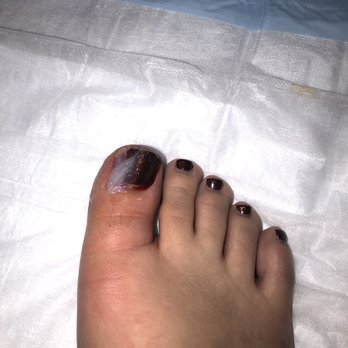 VJ Nails & Spa - After having my ingrown toenail removed. - Nail Salons Near Me - West Jordan, Utah VJ Nails & Spa - After having my ingrown toenail removed. - Nail Salons Near Me - West Jordan, Utah