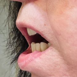 Lebanon Dental Care - I can't even close my mouth!