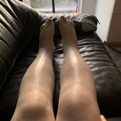 Lavar Spa - My legs the day before we went. Now the portion on the knee and right below looks much better, the ankles are still swollen.