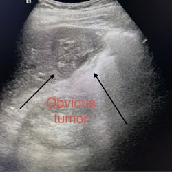 Kadlec Outpatient Imaging - Here is the liver cancer that Kadlec can't see.